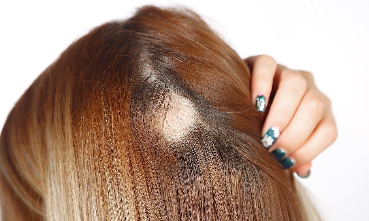 Top 73 Hairstyles For Frontal Fibrosing Alopecia In eteachers top-73-hairstyles-for-frontal-fibrosing-alopecia-in-eteachers