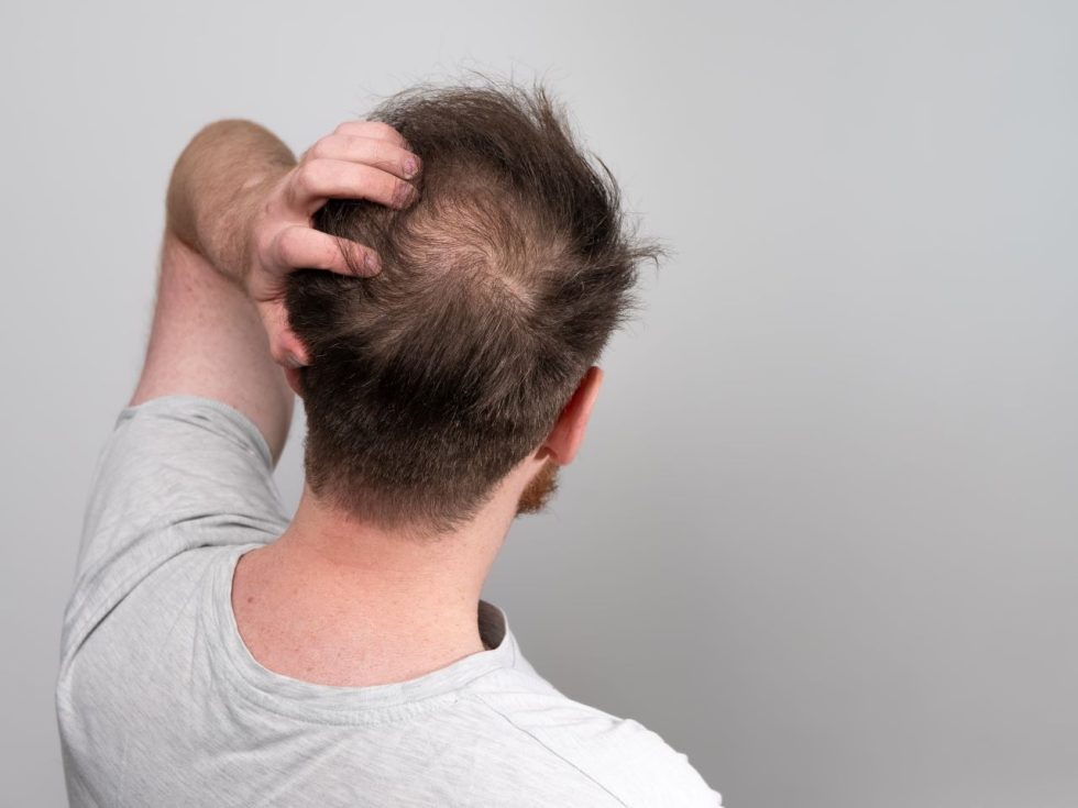 Spotting the early signs of male pattern baldness » Wigs4U
